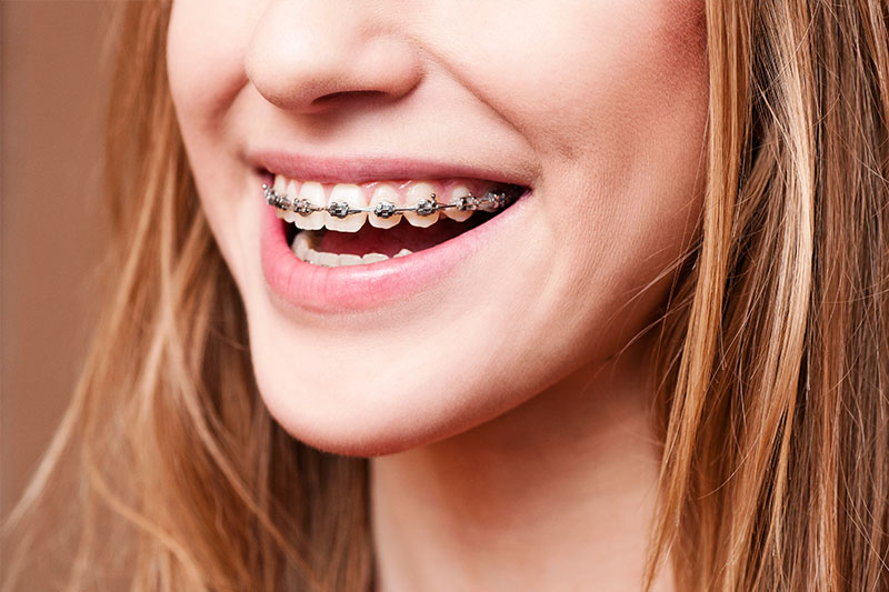 Orthodontics - Taylor St. Dental, Chicago Dentist