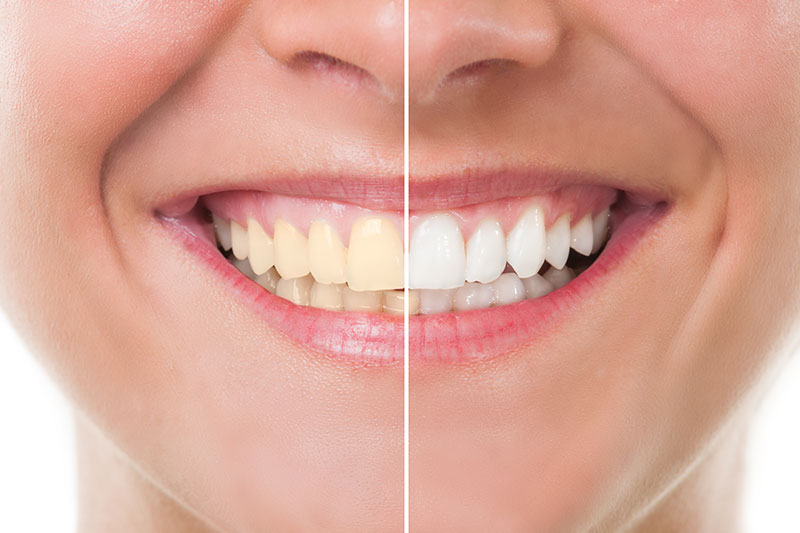 Teeth Whitening - Taylor St. Dental, Chicago Dentist
